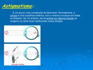 Astigmatismo:
É um pouco mais complicado de descrever. Normalmente, a
córnea é uma superfície esférica, com a mesma curvatura em todas
as direções. Se, no entanto, ela se achata em alguma direção as
imagens na retina ficam desfocadas nessa direção.
 