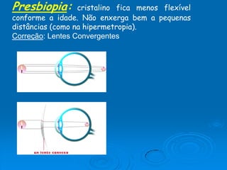 Presbiopia: cristalino fica menos flexível
conforme a idade. Não enxerga bem a pequenas
distâncias (como na hipermetropia).
Correção: Lentes Convergentes
 