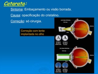 Catarata:
Sintoma: Embaçamento ou visão borrada.
Causa: opacificação do cristalino.
Correção: só cirurgia.
Correção com lente
implantada no olho
 