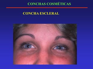 CONCHAS COSMÉTICAS
CONCHA ESCLERAL
 