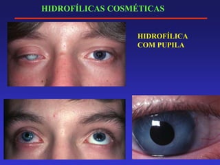 HIDROFÍLICAS COSMÉTICAS
HIDROFÍLICA
COM PUPILA
 
