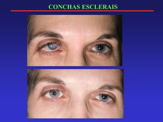 CONCHAS ESCLERAIS
 