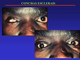 CONCHAS ESCLERAIS
 