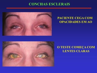 CONCHAS ESCLERAIS
PACIENTE CEGA COM
OPACIDADES EM AO
O TESTE COMEÇA COM
LENTES CLARAS
 