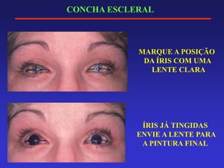 CONCHA ESCLERAL
MARQUE A POSIÇÃO
DA ÍRIS COM UMA
LENTE CLARA
ÍRIS JÁ TINGIDAS
ENVIE A LENTE PARA
A PINTURA FINAL
 