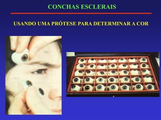 CONCHAS ESCLERAIS
USANDO UMA PRÓTESE PARA DETERMINAR A COR
 