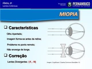 FÍSICA, 2º
Lentes Esféricas

 Características
Olho Apertado;
Imagem forma-se antes da retina;
Problema no ponto remoto;
Não enxerga de longe.

 Correção
Lentes Divergentes (-f , -V)

Imagem: CryptWizard / Creative Commons ShareAlike 1.0.

 