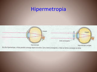 Hipermetropia
 