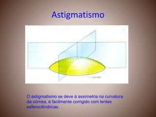 Astigmatismo
O astigmatismo se deve à assimetria na curvatura
da córnea, é facilmente corrigido com lentes
esferocilíndricas.
 