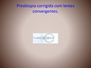 Presbiopia corrigida com lentes
convergentes.
 