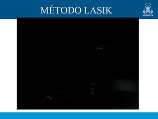 MÉTODO LASIK
 