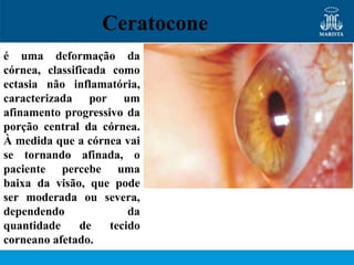 Ceratocone
é uma deformação da
córnea, classificada como
ectasia não inflamatória,
caracterizada por um
afinamento progressivo da
porção central da córnea.
À medida que a córnea vai
se tornando afinada, o
paciente percebe uma
baixa da visão, que pode
ser moderada ou severa,
dependendo               da
quantidade     de    tecido
corneano afetado.
 