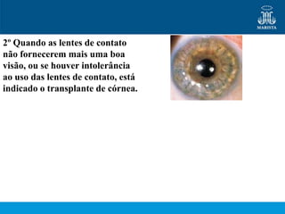 2º Quando as lentes de contato
não fornecerem mais uma boa
visão, ou se houver intolerância
ao uso das lentes de contato, está
indicado o transplante de córnea.
 