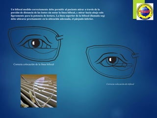 Un bifocal medido correctamente debe permitir al paciente mirar a través de la
porción de distancia de las lentes sin notar la línea bifocal, y mirar hacia abajo solo
ligeramente para la potencia de lectura. La línea superior de la bifocal (llamada seg)
debe ubicarse precisamente en la ubicación adecuada, el párpado inferior.
Correcta colocación de la línea bifocal
Correcta colocación de trifocal
 