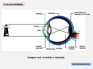 O OLHO NORMAL


                                                              ESCLERÓTICA
                       CÓRNEA     CORÓIDE
                                                              (BRANCO DO OLHO)




                     PUPILA

                         ÍRIS




                       HUMOR                         HUMOR         NERVO
                       AQUOSO                                      ÓPTICO
                                CRISTALINO RETINA    VÍTREO




                Imagem real, invertida e reduzida.

                                                        www.fisicaatual.com.br
 