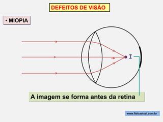 DEFEITOS DE VISÃO

• MIOPIA




                                          I




           A imagem se forma antes da retina

                                         www.fisicaatual.com.br
 