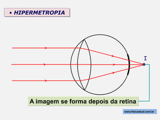 • HIPERMETROPIA




                                                 I




     A imagem se forma depois da retina
                                   www.fisicaatual.com.br
 