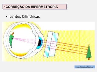 • CORREÇÃO DA HIPERMETROPIA


 • Lentes Cilíndricas




                              www.fisicaatual.com.br
 