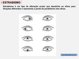 • ESTRABISMO
 Estrabismo é um tipo de alteração ocular que desalinha os olhos para
 direções diferentes e representa a perda do paralelismo dos olhos.




                                                       www.fisicaatual.com.br
 
