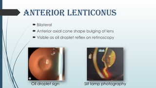 Lenticonus_ophthal 1234567890 by kamal.pptx