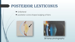 Lenticonus_ophthal 1234567890 by kamal.pptx
