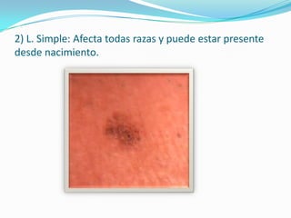 2) L. Simple: Afecta todas razas y puede estar presente
desde nacimiento.