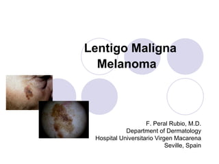   Lentigo Maligna Melanoma   F. Peral Rubio, M.D. Department of Dermatology Hospital Universitario Virgen Macarena Seville, Spain 