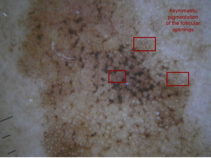 Lentigo maligna melanoma