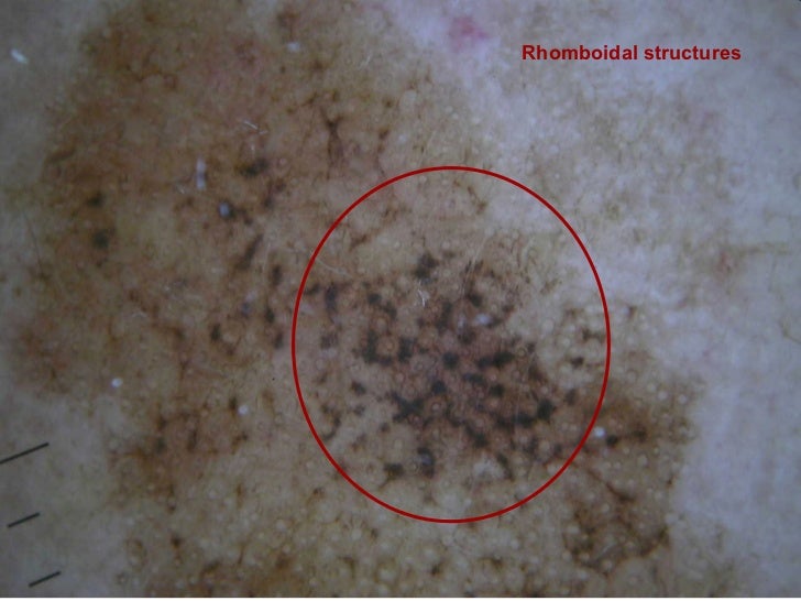 Lentigo maligna melanoma