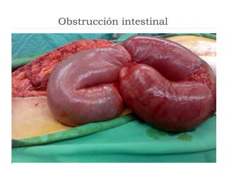 Obstrucción intestinal
 