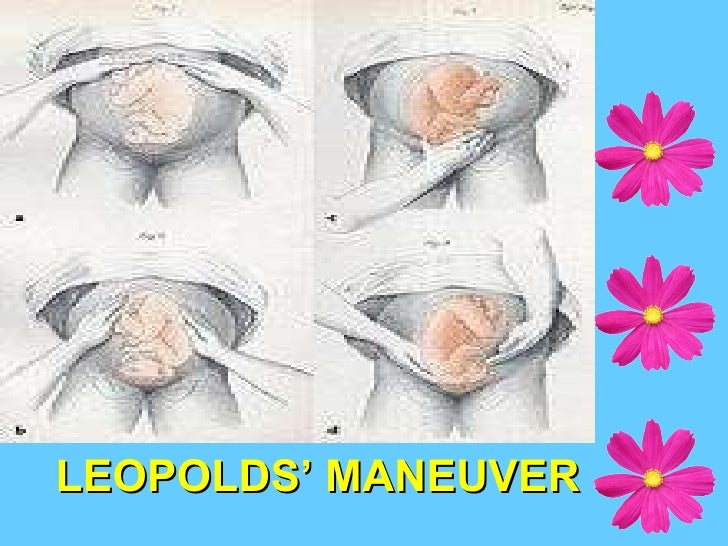 leopold maneuver