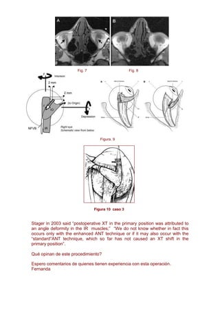 Fig. 7                      Fig. 8




                                  Figura. 9




                               Figura 10 caso 3


Stager in 2003 said                                        position was attributed to

occurs only with the enhanced ANT technique or if it may also occur with the
                                   far has not caused an XT shift in the
                .

Qué opinan de este procedimiento?

Espero comentarios de quienes tienen experiencia con esta operación.
Fernanda
 