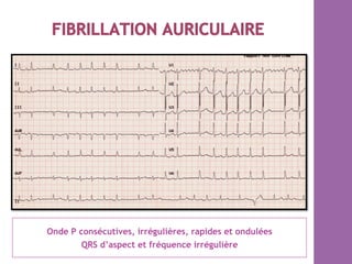 Onde P consécutives, irrégulières, rapides et ondulées
QRS d’aspect et fréquence irrégulière
 