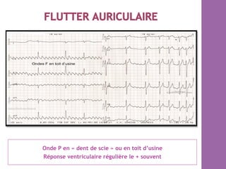 Onde P en « dent de scie » ou en toit d’usine
Réponse ventriculaire régulière le + souvent
 
