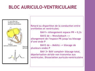 Retard ou disparition de la conduction entre
oreillettes et ventricules:
BAV1= Allongement espace PR > 0,2s
BAV2 de « Wenckebach »=
allongement de l’espace PR jusqu’au blocage
d’une onde P
BAV2 de « Mobitz »= blocage de
plusieurs ondes P
BAV 3= BAV complet= blocage total,
dépolarisation atriale non transmise aux
ventricules. Dissociation auriculo-ventriculaire
 