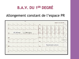 Allongement constant de l’espace PR
 
