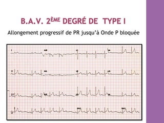 Allongement progressif de PR jusqu’à Onde P bloquée
 