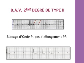 Blocage d’Onde P, pas d’allongement PR
 