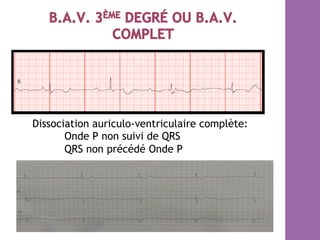Dissociation auriculo-ventriculaire complète:
Onde P non suivi de QRS
QRS non précédé Onde P
 