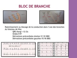 Ralentissement ou blocage de la conduction dans l’une des branches
du faisceau de Hiss
QRS élargi > 0,12s
Ondes R R’
Dérivations précordiales droites V1 V2 BBD
Dérivations précordiales gauches V5 V6 BBG
 