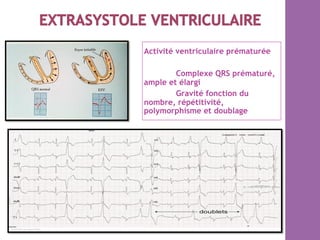 Activité ventriculaire prématurée
Complexe QRS prématuré,
ample et élargi
Gravité fonction du
nombre, répétitivité,
polymorphisme et doublage
 