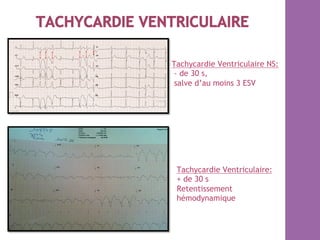 Tachycardie Ventriculaire NS:
- de 30 s,
salve d’au moins 3 ESV
Tachycardie Ventriculaire:
+ de 30 s
Retentissement
hémodynamique
 