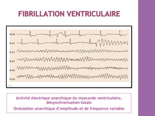 Activité électrique anarchique du myocarde ventriculaire.
Désynchronisation totale
Ondulation anarchique d’amplitude et de fréquence variable
 