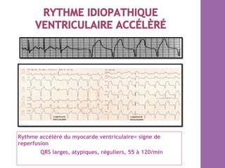 Rythme accéléré du myocarde ventriculaire= signe de
reperfusion
QRS larges, atypiques, réguliers, 55 à 120/min
 