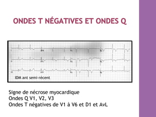 Signe de nécrose myocardique
Ondes Q V1, V2, V3
Ondes T négatives de V1 à V6 et D1 et AvL
IDM ant semi-récent
 