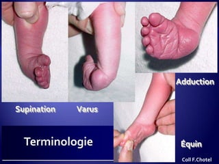 Supination Varus
Adduction
ÉquinTerminologie
Coll F.Chotel
 