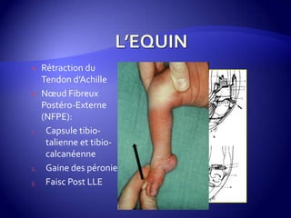  Rétraction du
Tendon d’Achille
 Nœud Fibreux
Postéro-Externe
(NFPE):
1. Capsule tibio-
talienne et tibio-
calcanéenne
2. Gaine des péroniers
3. Faisc Post LLE
 