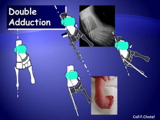 Double
Adduction
Coll F.Chotel
 