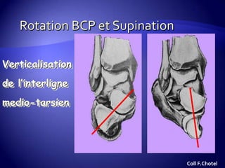 Verticalisation
de l’interligne
medio-tarsien
Coll F.Chotel
 