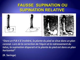 FAUSSE SUPINATION OU
SUPINATION RELATIVE
"Dans un P.B.V.E invétéré, la plante du pied se situe dans un plan
coronal. Lors de la correction de l’équin et le redressement du
talus, la supination disparait et la plante du pied est dans un plan
horizontal"
(R. Seringe)
 